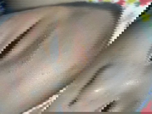 BÉ BỊ NỔI ĐỎ