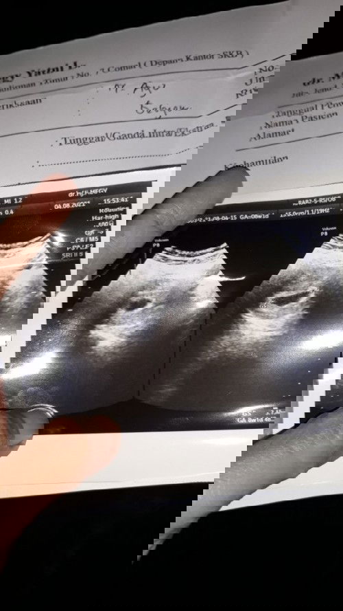 Hamil 8 minggu usg belum kelihatan janin...
