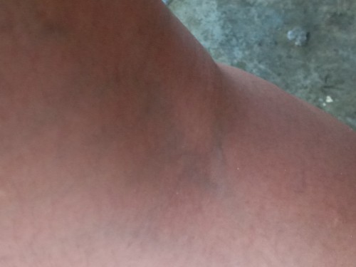 Ano po pwede gamot sa varicose vein?