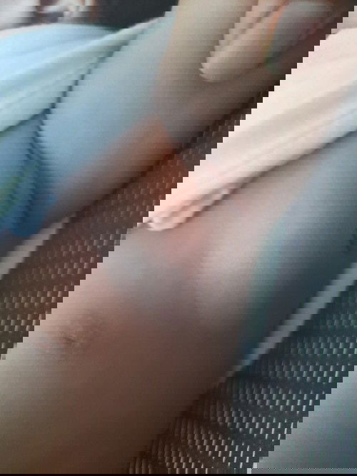 Các m ơi con của các m có bị giống con e ko bé chích ngừa lao bị hành nổi z ák