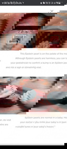 Biji putih pada gusi bayi 6 bulan