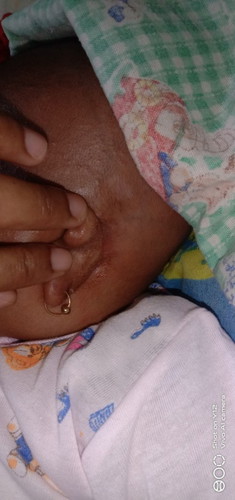 Maaf Bun adakah yg pnh ngalamin anaknya SPT anak saya,,awalnya itu biang keringat..tp mlh kaya gitu.