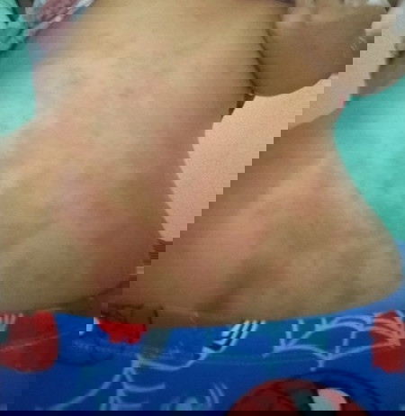 33 weeks pregnant
Rash