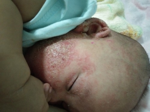 ลูกผิวหนังติดเชื้อสอบถามหน่อยค่ะ