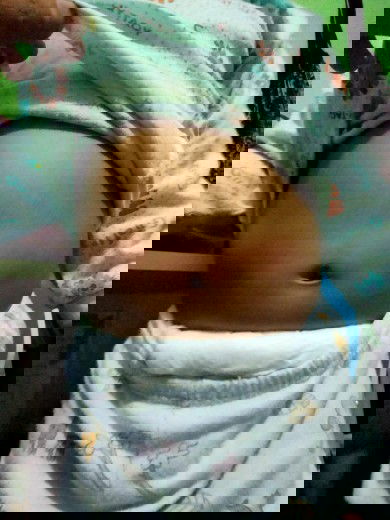 Ruam diperut pada anak