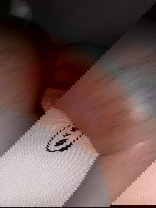 Memar di kaki pada bayi 4bulan