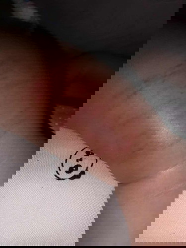 Memar di kaki pada bayi 4bulan