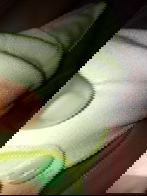 gatal atau biang keringat