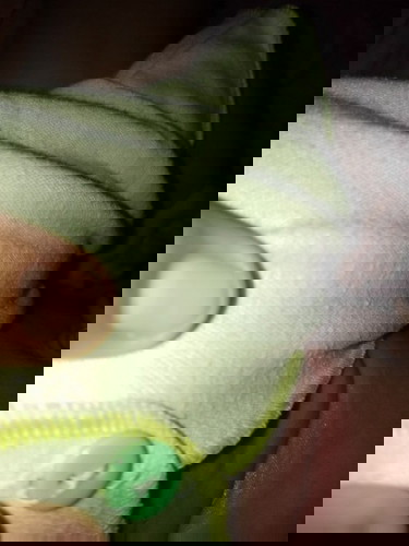 gatal atau biang keringat