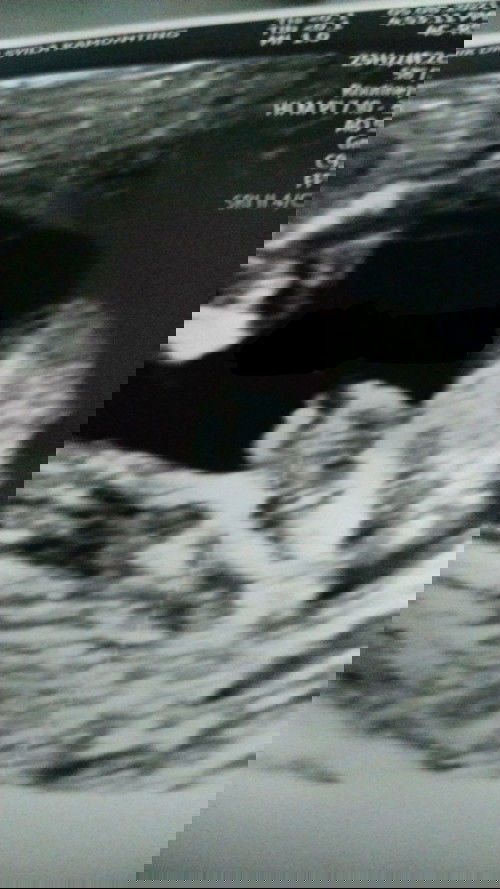 Nak tanya ibu ibu. Girl atau boy? Scan 22 minggu