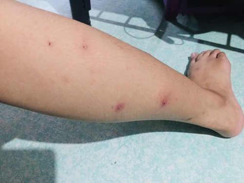 Sugat na nag na nana