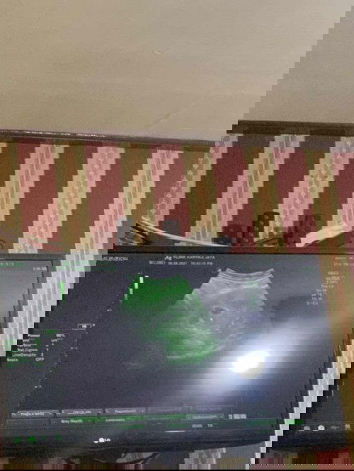 5 week baru kantung kehamilan kah bun?