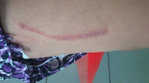 Herpes Zoster/Muntah ular