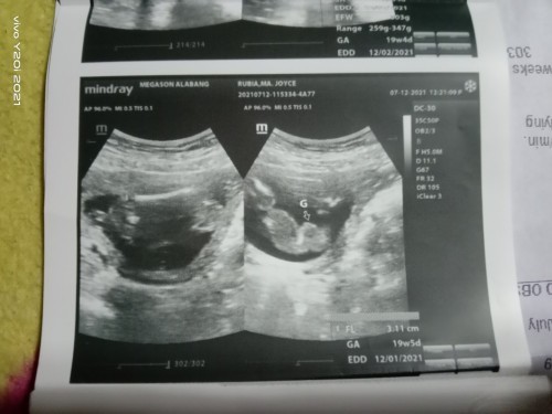 20weeks breech position🥺