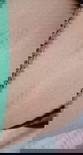 ผื่นเเดงขอบกางเกงบริเวณเอว