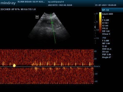 Usg 14 wek di bidan yang berbeda di tempat yang tidak sama sebelum nya, dan apa ini bener