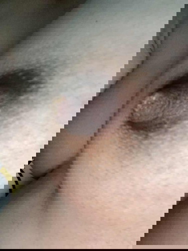 ถามแม่ให้นมลูก หัวนมพองแบบนี้คืออะไรคะ ต้องเจาะไหม ถ้าแตกเป็นอันตรายไหมคะ