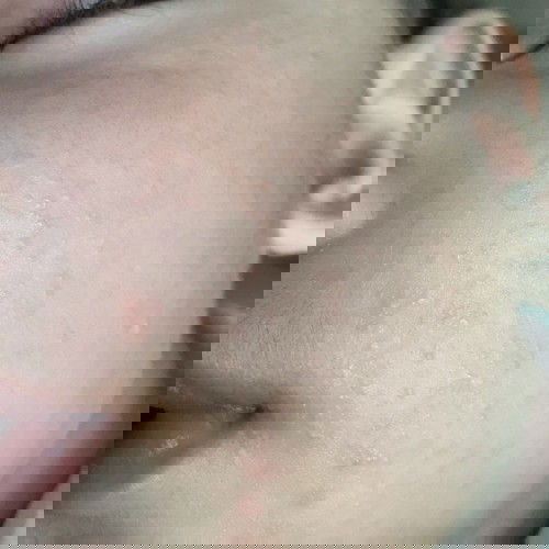 Dry skin, white and red bumps