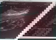 พึ่งตรวจวันนี้ค่ะ