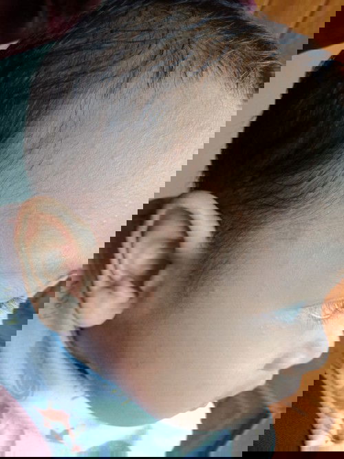 Beruntusan pd kulit bayi