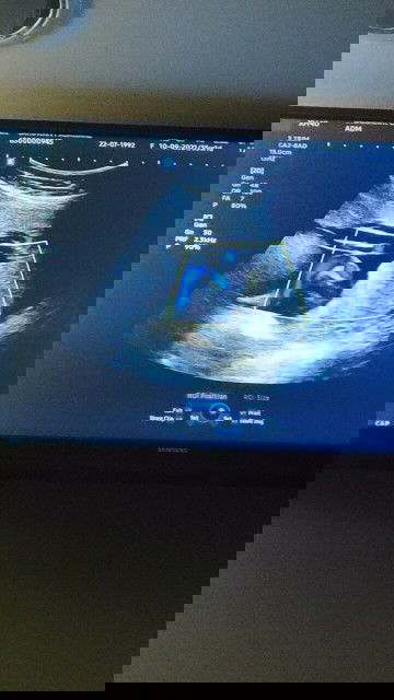 ฉีดวัคซีนป้องกันโควิด?? อายุครรภ์35Week