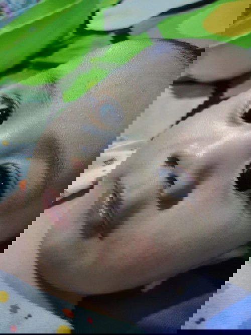 bintik bintik di wajah bayi