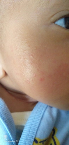 Beruntus di wajah, dan putih seperti panu di leher