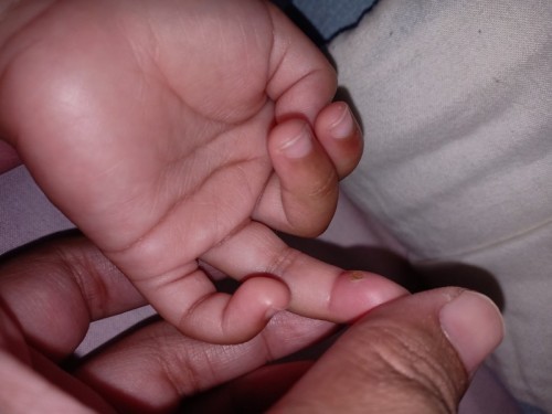 Obat luka bayi 11 bulan