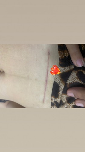 รักษารอยแผลผ่าตัด