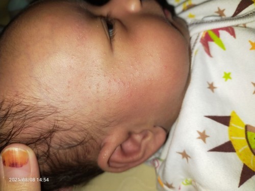 Muka si bayi beruntusan