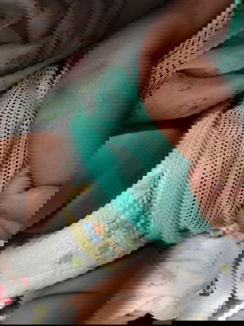 ขึ้นผื่นตรงต้นแขน