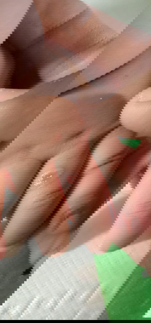 luka berair pada bayu