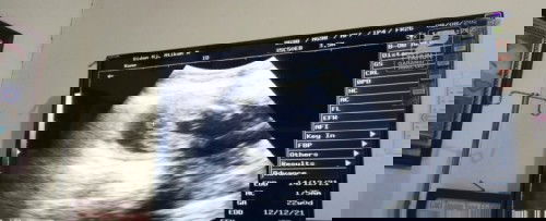 Share hasil Usg JK (Jenis kelamin)