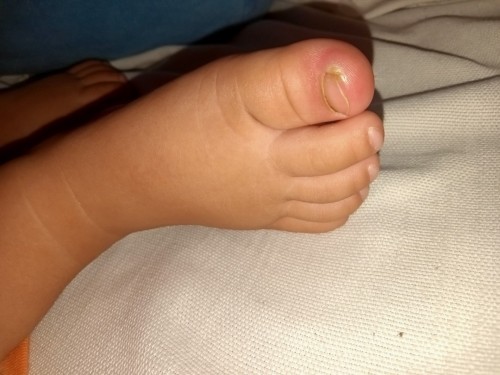 Ingrown for Infant 😔