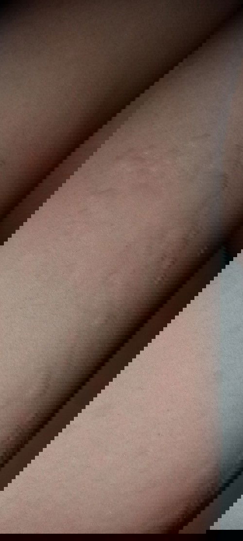 Klu bumil biduran obatnya apa ya ?