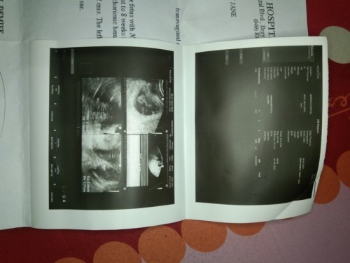 Normal lang po ba na 8 weeks na po baby ko sa tummy ko pero Wala pa din sya heartbeat 🤧🥺 ?? .....
