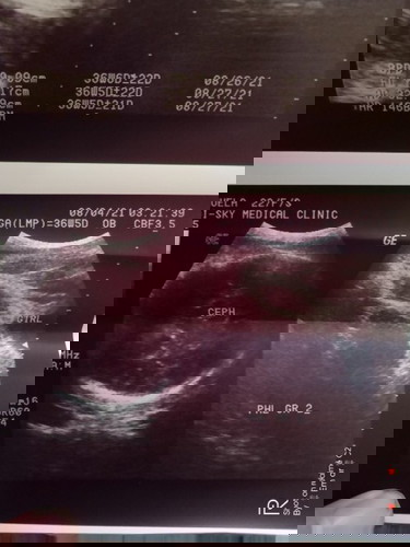 Hello po.
Ask ko lang po sana kung paano magbasa ng gender ultrasound hehe. Di po masyado naexplain