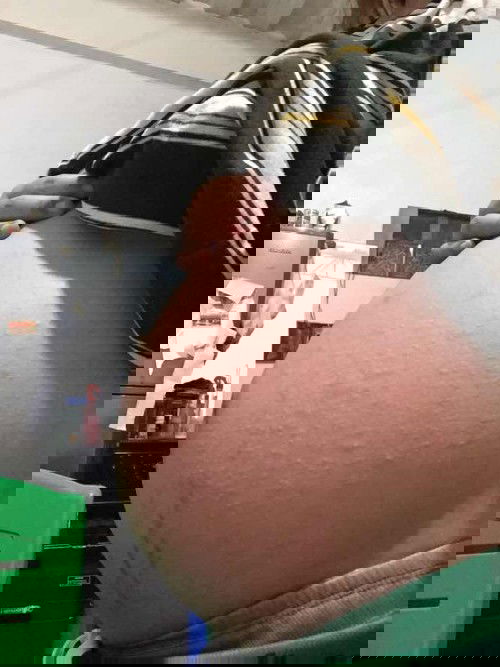 hi mamsh pakisagot naman po. Normal lg po ba na maraming tumutubo na ganyan sa tyan ko? Makati po sya.  36weeks napo ako