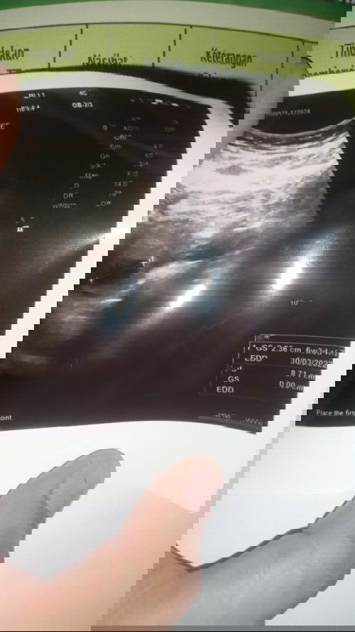 Baca usg ini gimana yah