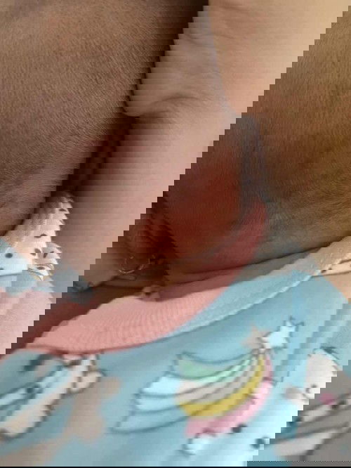 Bayi tbtb muncul ruam dan bintik” dimuka