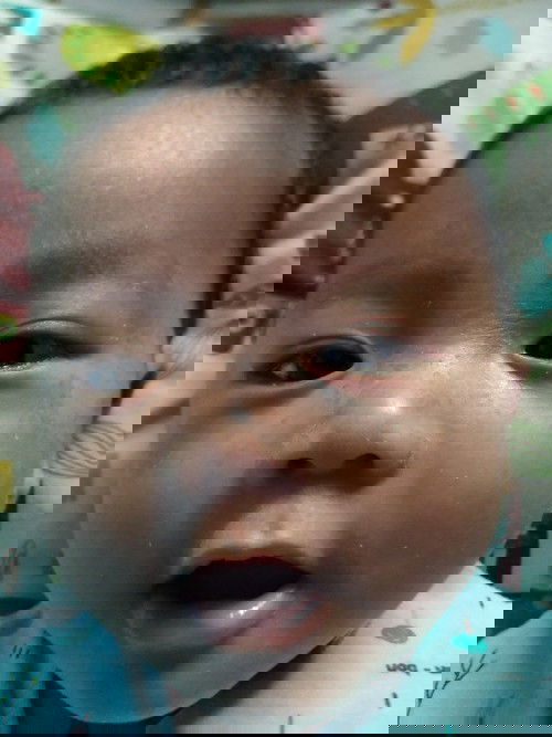 Kulit bayi mengelupas