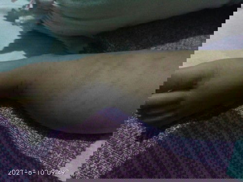 Bintik hitam dibawah kulit