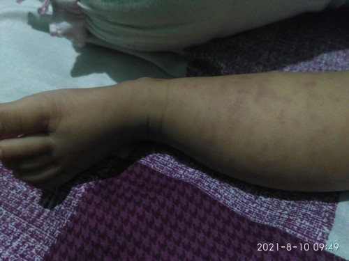 Bintik hitam dibawah kulit