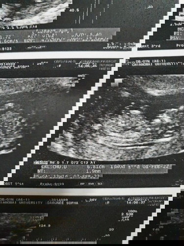 คนเป็นแม่แทบใจสลาย
           พอดีหมอ ให้ตรวจเจาะชิ้นเนื้อเนื่องจากพ่อกับแม่เป็นแฝงธาลัชซิเมีย