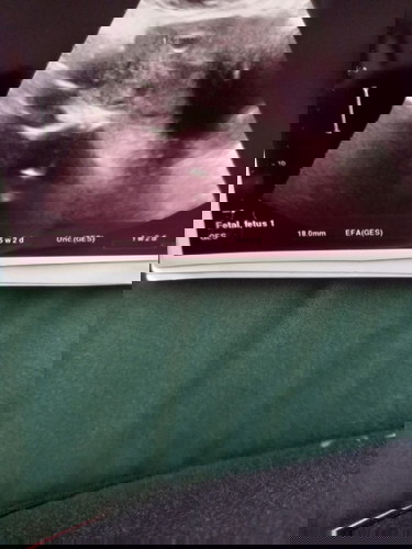 USG kehamilan tidak sesuai HPHT