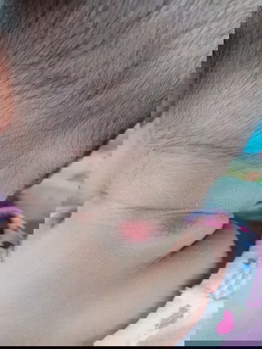 คอลูกเป็นผื่นแดง