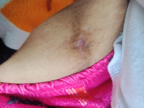 Ask ko lang po caesarian po ako tapos ganyan po nangyari sa bandang itaas ng tahi ko?Normal lang po