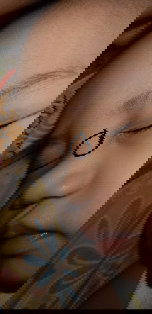 Keloid in my baby (2yrs old and 2mos)