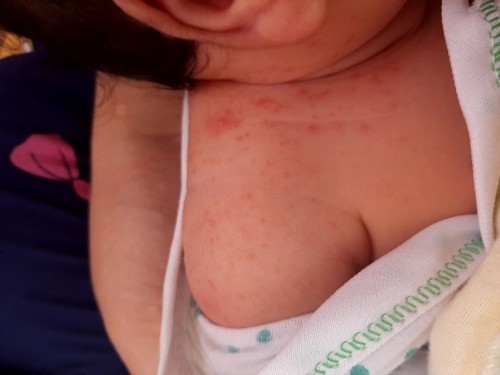 Bé e bị vầy phải làm gì cho hết các mẹ ơi