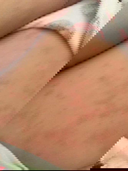 Ano po tong tumubo sa katawan ng anak ko?